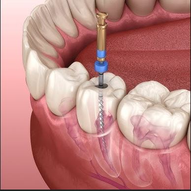 Implantes de dientes