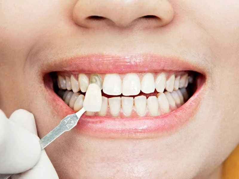 Implantes de dientes